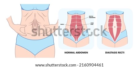 Diastasis Recti six pack separation belly rectus Linea alba abdominal surgical Tummy Tuck skin fat loss c section Ovary Over consuming Bloated Stressed Out childbirth Royalty-Free Stock Photo #2160904461