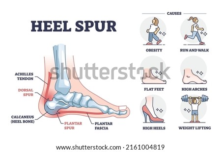 Heel spur problem or calcaneal bone condition causing pain in feet outline diagram. Labeled educational medical scheme with achilles tendon and plantar fascia inflammation anatomy vector illustration. Royalty-Free Stock Photo #2161004819