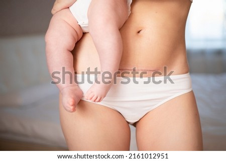 Mom's abdomen after cesarean section. Scar seam. A young mother holds the baby in her arms. Real motherhood. Lifestyle. High quality photo Royalty-Free Stock Photo #2161012951
