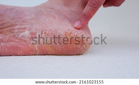 Wart verrucas plantar. Fasciitis Wart on foot. Warts plantar verruca foot Royalty-Free Stock Photo #2161023155