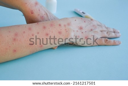 Monkey pox virus, a new world problem of modern humanity. Close-up of the hands of a sick person with pimples and blisters. Smallpox vaccine. Royalty-Free Stock Photo #2161217501