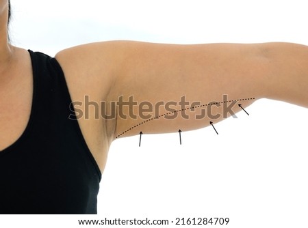 Plastic surgery doctor draw line on patient arm. Woman with excess fat on her upper arm with marks for liposuction or plastic surgery isolated on white, cosmetic surgery concept.  Royalty-Free Stock Photo #2161284709