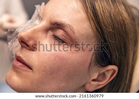 After a plasma fibroblast skin tightening treatment used on the eyelids Royalty-Free Stock Photo #2161360979