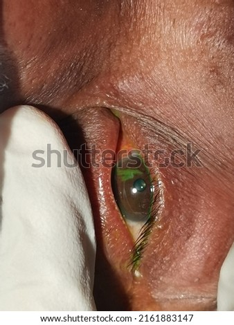 Selective Focus of Corneal Abrassion over Left Eye. Royalty-Free Stock Photo #2161883147