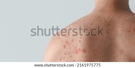 Male back affected by blistering rash because of monkeypox or other viral infection on white background Royalty-Free Stock Photo #2161975775