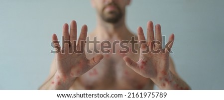 Male hands affected by blistering rash because of monkeypox or other viral infection on white background Royalty-Free Stock Photo #2161975789