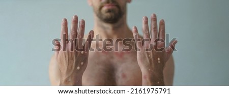 Male hands affected by blistering rash because of monkeypox or other viral infection on white background Royalty-Free Stock Photo #2161975791
