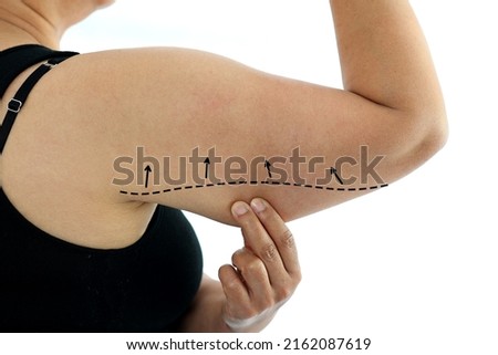 Plastic surgery doctor draw line on patient arm. Woman with excess fat on her upper arm with marks for liposuction or plastic surgery isolated on white, cosmetic surgery concept.  Royalty-Free Stock Photo #2162087619