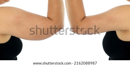 Comparison before and after Obesity Cellulite And Fat Removal liposuction Surgery on upper arm to get rid of sagging fat arm skin. Brachioplasty or Upper-Arm Lift plastic surgery in Asian woman.  Royalty-Free Stock Photo #2162088987