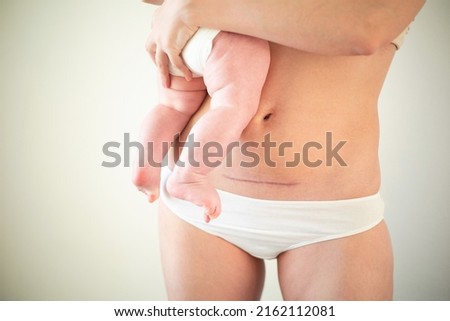 Mom's abdomen after cesarean section. Scar seam. A young mother holds the baby in her arms. Real motherhood. Lifestyle. High quality photo Royalty-Free Stock Photo #2162112081