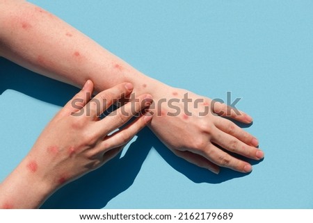 Monkeypox new disease dangerous over the world. Patient with Monkey Pox. Painful rash, red spots blisters on the hand. Close up rash, human hands with Health problem. Banner, copy space. Dengue fever Royalty-Free Stock Photo #2162179689