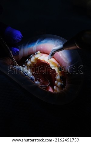 The dentist treats the patient's teeth with dental equipment and holds dental instruments near the teeth. Close-up. Dentist.