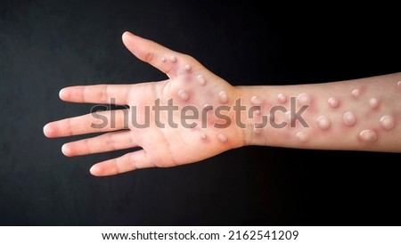 MONKEYPOX. The arm is blistered from monkeypox. Virus, epidemic, disease. Black background. Royalty-Free Stock Photo #2162541209