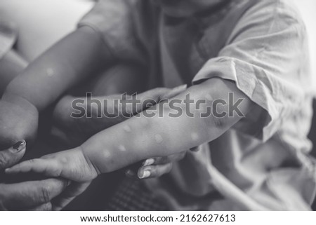 Monkeypox infection.African toddler child hand symptom monkeypox show doctor in laboratory lab confirm.Monkeypox is a rare disease infection virus.kid Health.infection in Africa Europe.hand virus.uk Royalty-Free Stock Photo #2162627613