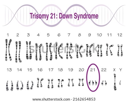 Trisomy 21 Down Syndrome Karyotype Royalty-Free Stock Photo #2162654853