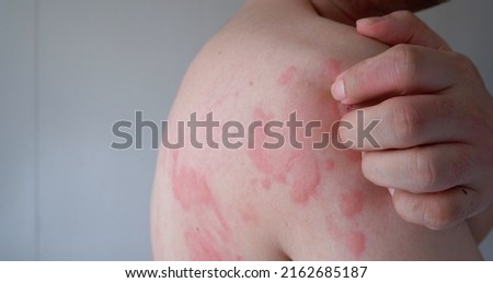 Close up image of skin texture suffering severe urticaria or hives or kaligata on back. Allergy symptoms. Royalty-Free Stock Photo #2162685187