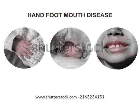 A bunch of hand foot mouth disease. Set of baby body details in circles isolated on white background. modern line art collage