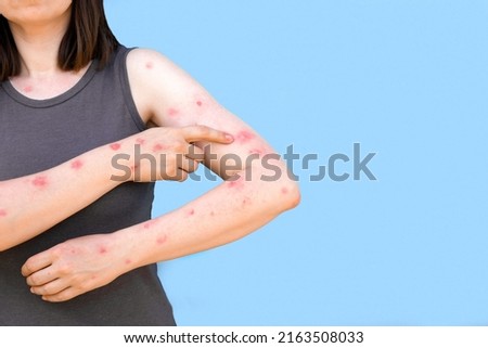 Monkeypox new disease dangerous over the world. Patient with Monkey Pox. Painful rash, red spots blisters on the hand. Close up rash, human hands with Health problem. Banner, copy space. Royalty-Free Stock Photo #2163508033