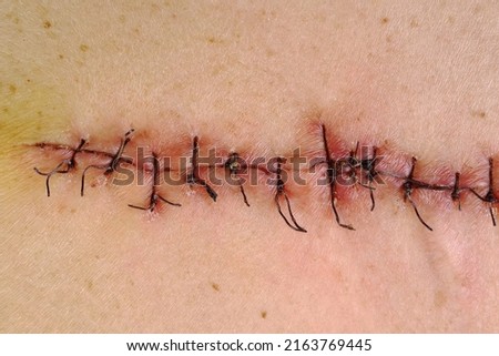 Medical sutures, stitches after surgery, stitched surgical sutures on human body. Medical surgical care. Close-up. Royalty-Free Stock Photo #2163769445