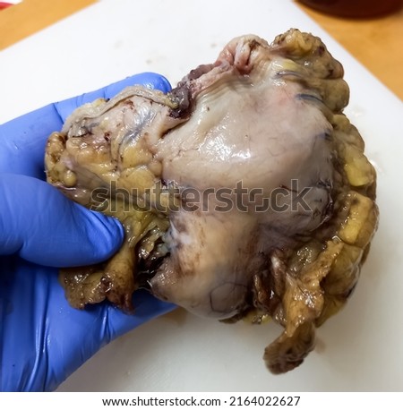 Resected lower part of stomach at laboratory for biopsy. Gastric biopsies. Royalty-Free Stock Photo #2164022627