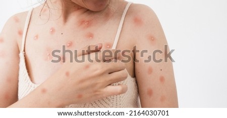 Concept of monkeypox epidemic, white woman Skin erythema, pustules, and boils, itching after being infected with the monkeypox virus. Royalty-Free Stock Photo #2164030701