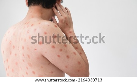 Concept of monkeypox epidemic, white man Skin erythema, pustules, and boils, itching after being infected with the monkeypox virus. Royalty-Free Stock Photo #2164030713