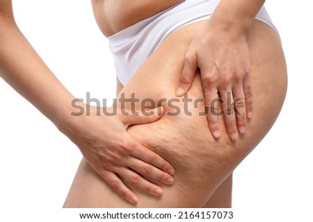 The girl stretches the skin on her leg, showing fat deposits and cellulite. The concept of weight loss and healthy lifestyle. Royalty-Free Stock Photo #2164157073