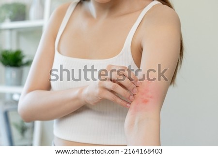 Dermatology asian young woman, girl allergy, allergic reaction from atopic, insect bites on her arm, hand in scratching itchy, itch red spot or rash of skin. Healthcare, treatment of beauty. Royalty-Free Stock Photo #2164168403