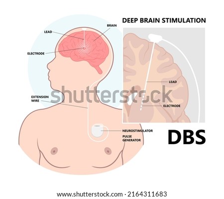 Deep brain stimulation or DBS treat Parkinson's disease PD and TMS condition major neural stimulator pulse neurological wave implanted Motor bipolar  Royalty-Free Stock Photo #2164311683