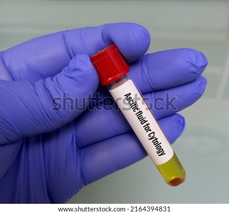 Oncologist hold Ascitic fluid sample for cytological test. Peritoneal cavity fluid. Oncology. Royalty-Free Stock Photo #2164394831