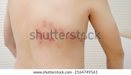 man with shingles disease on skin and he feel very painful Royalty-Free Stock Photo #2164749561