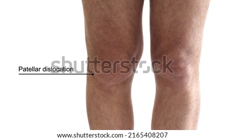 Adult man's leg Torn Medial Patellae dislocation (focus is on the kneecaps) Royalty-Free Stock Photo #2165408207