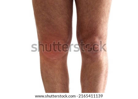 Knee effusion, fluid or water round the knee joint. Adult man with knee swollen the swelling and redness of the skin because of fluid build up inside.  Royalty-Free Stock Photo #2165411139
