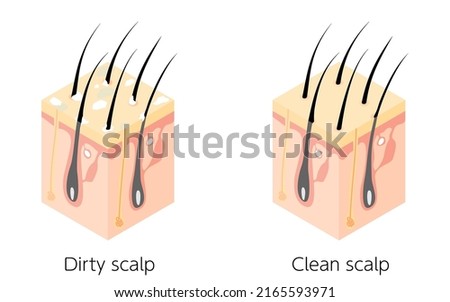 Diagrammatic illustration of a cross section of a dirty scalp and a clean scalp, isometric