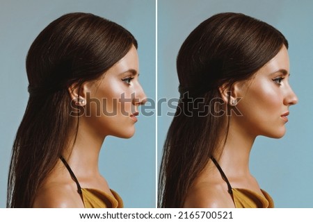 rhinoplasty before and after correction, young girl in profile Royalty-Free Stock Photo #2165700521