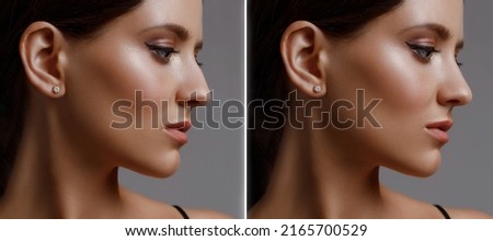 rhinoplasty before and after correction, young girl in profile