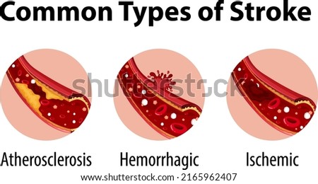Infographic of common types of stroke illustration
