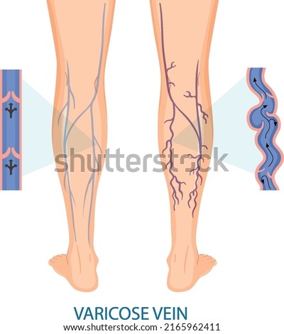 Human legs with varicose vein illustration Royalty-Free Stock Photo #2165962411