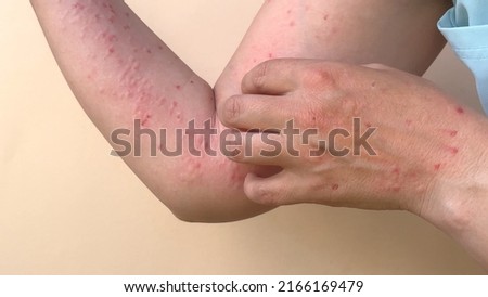 Monkey pox virus, a new world problem of modern humanity. Banner with hands of a sick person with pimples and blisters. Smallpox vaccine. Royalty-Free Stock Photo #2166169479