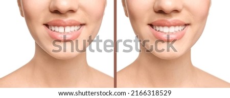 Collage with photos of woman with diastema between upper front teeth before and after treatment on white background, closeup. Banner design Royalty-Free Stock Photo #2166318529
