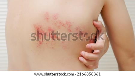 man with shingles disease on skin and he feel very painful Royalty-Free Stock Photo #2166858361