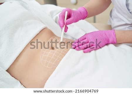 Doctor making marks on woman abdomen before non invasive fat reduction injection Royalty-Free Stock Photo #2166904769