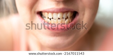 Close up of young woman's face with crooked teeth. Teeth before install braces. Teeth need ortodonti. Royalty-Free Stock Photo #2167011543