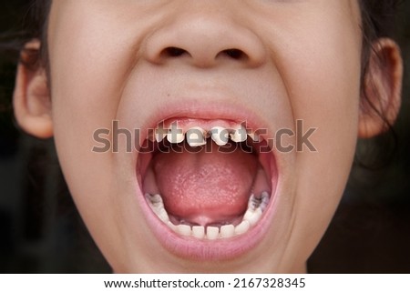 Little Asian girl with open mouth showing damaged teeth with cavity dental caries. Dental medicine and healthcare.  Royalty-Free Stock Photo #2167328345