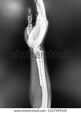 X-ray of the broken leg  Many others X-ray images in my portfolio.