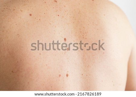 Pigmentation. Close up detail of the bare skin on a man back with scattered moles and freckles. Checking benign moles. Birthmarks on skin Royalty-Free Stock Photo #2167826189