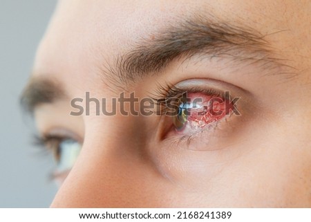 Close up of male brown bloodshot eyes and redness with vessels. Concept of keratitis, inflammation and ophthalmology. Royalty-Free Stock Photo #2168241389