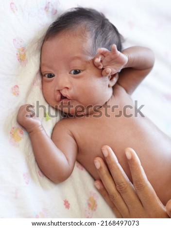 The loving touch of a mother. A young mother placing her hand on her baby with a cleft palate. Royalty-Free Stock Photo #2168497073