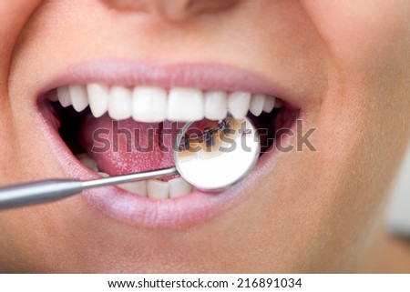 lingual braces on dental mirror, close up  Royalty-Free Stock Photo #216891034