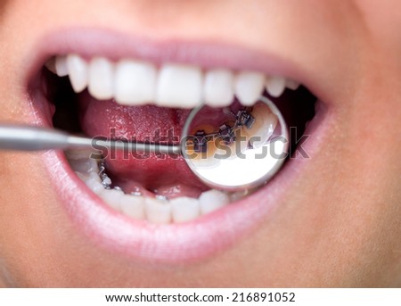 Female patient showing her invisible lingual braces braces on dental mirror Royalty-Free Stock Photo #216891052